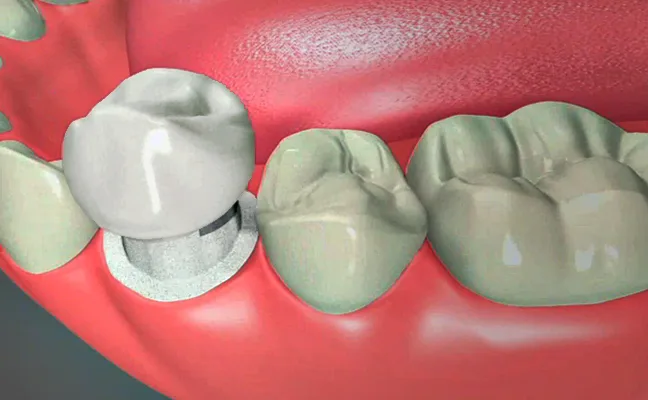Dental Crowns
