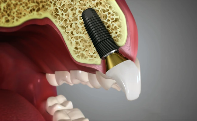 Dental Implants Dental Implants