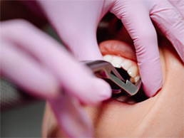 Wisdom Teeth Extractions