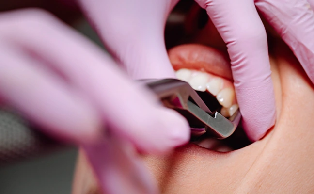Wisdom Teeth Extractions Wisdom Teeth Extractions