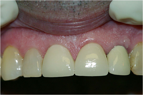 Dental Crowns and Bridges After