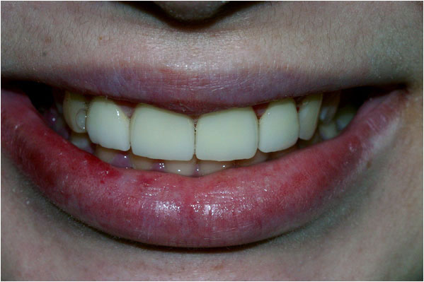 Dental Veneers After