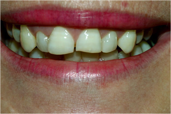 Dental Veneers Before